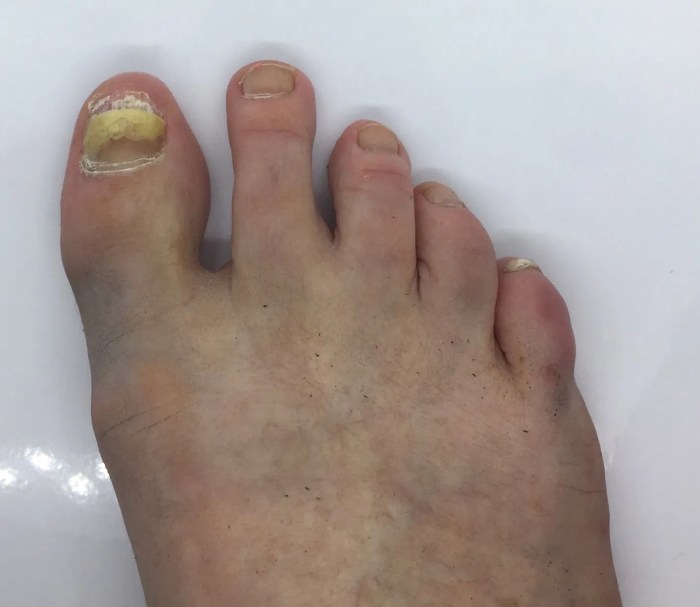False Toe Nails & Fungal Nail Infection